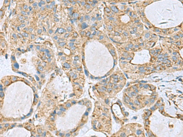 Immunohistochemistry of paraffin-embedded Human thyroid cancer tissue  using CLTB Polyclonal Antibody at dilution of 1:70(?200)