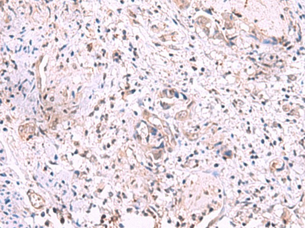 Immunohistochemistry of paraffin-embedded Human cervical cancer tissue  using KIR3DL1 Polyclonal Antibody at dilution of 1:95(?200)