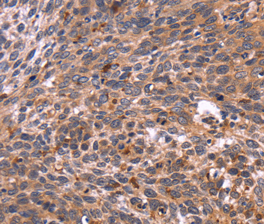 Immunohistochemistry of paraffin-embedded Human cervical cancer tissue using CRK Polyclonal Antibody at dilution 1:40