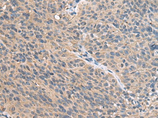 Immunohistochemistry of paraffin-embedded Human cervical cancer tissue  using FAM19A4 Polyclonal Antibody at dilution of 1:55(?200)