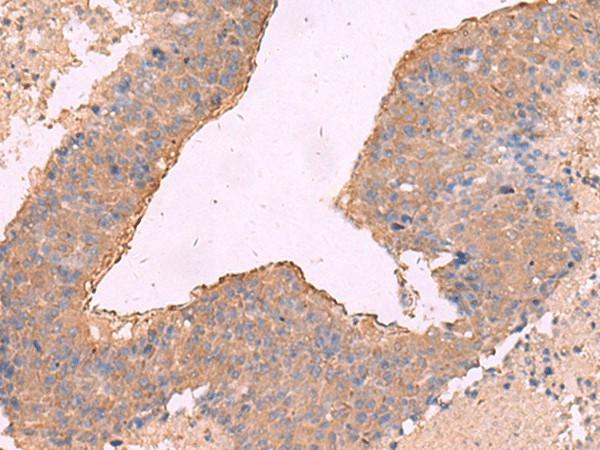 Immunohistochemistry of paraffin-embedded Human liver cancer tissue  using NIPSNAP1 Polyclonal Antibody at dilution of 1:50(?200)