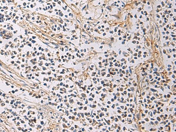 Immunohistochemistry of paraffin-embedded Human breast cancer tissue  using GMPR Polyclonal Antibody at dilution of 1:60(?200)