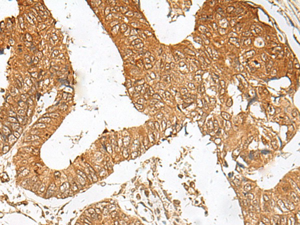 Immunohistochemistry of paraffin-embedded Human colorectal cancer tissue  using ZBTB8A Polyclonal Antibody at dilution of 1:100(?200)