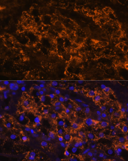 Immunofluorescence analysis of Human kidney cancer using SLC7A9 Polyclonal Antibody at dilution of 1:100. Blue: DAPI for nuclear staining.