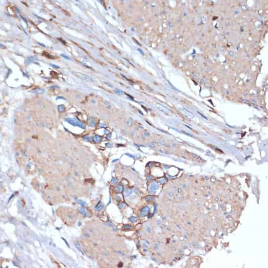 Immunohistochemistry of paraffin-embedded Human gastric cancer using CD44 Polyclonal Antibody at dilution of 1:200 (40x lens).