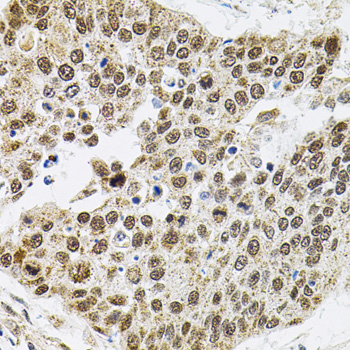 Immunohistochemistry of paraffin-embedded Human lung cancer using BAF60a Polyclonal Antibody at dilution of 1:100 (40x lens).