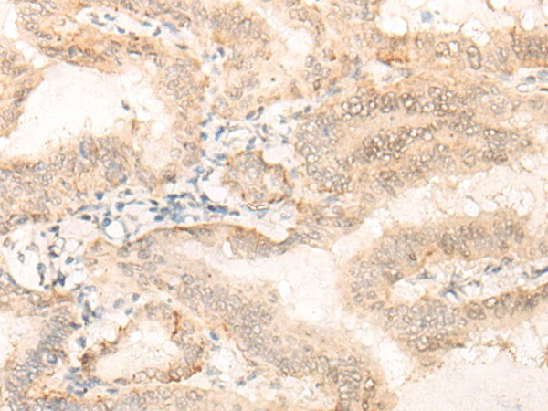 Immunohistochemistry of paraffin-embedded Human thyroid cancer tissue  using EIF4A3 Polyclonal Antibody at dilution of 1:35(?200)