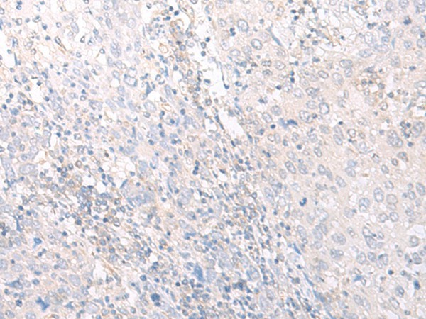 Immunohistochemistry of paraffin-embedded Human cervical cancer tissue  using HLA-C Polyclonal Antibody at dilution of 1:25(?200)