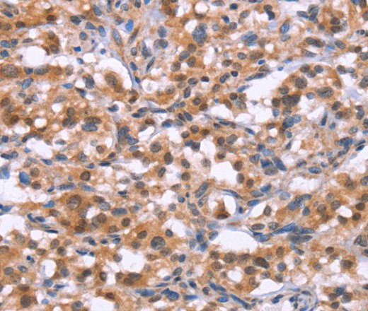 Immunohistochemistry of paraffin-embedded Human thyroid cancer tissue using BRK1 Polyclonal Antibody at dilution 1:30