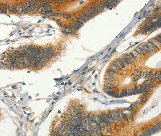 Immunohistochemistry of paraffin-embedded Human colon cancer tissue using CIB1 Polyclonal Antibody at dilution 1:30