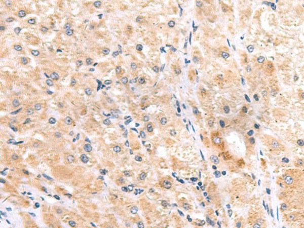 Immunohistochemistry of paraffin-embedded Human liver cancer tissue  using ITGA3 Polyclonal Antibody at dilution of 1:45(?200)