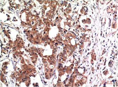 Immunohistochemistry of paraffin-embedded Human breast carcinoma tissue using GSK3 beta Monoclonal Antibody at dilution of 1:200.