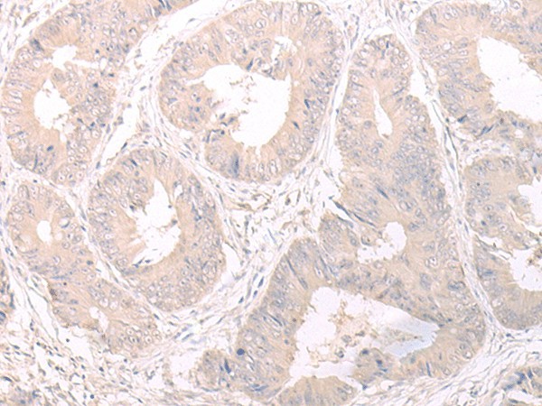 Immunohistochemistry of paraffin-embedded Human colorectal cancer tissue  using FOXRED2 Polyclonal Antibody at dilution of 1:35(?200)