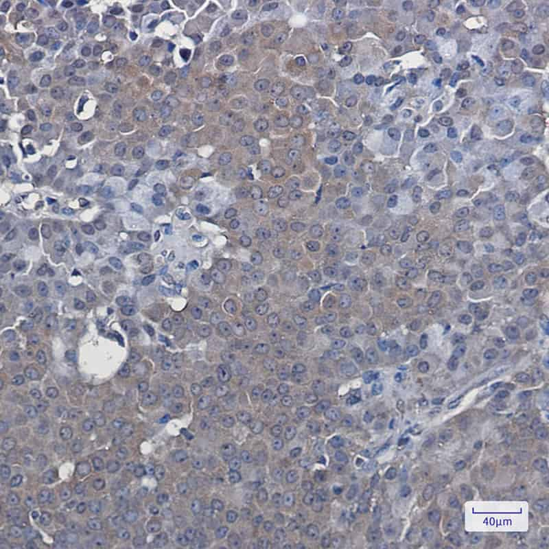 Immunohistochemistry of LXR alpha in paraffin-embedded Human breast cancer tissue using LXR alpha Rabbit mAb at dilution 1:50