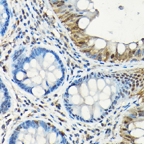 Immunohistochemistry of paraffin-embedded human colon using Smad5 Polyclonal Antibody at dilution of 1:150 (40x lens).Perform high pressure antigen retrieval with 10 mM citrate buffer pH 6.0 before commencing with IHC staining protocol.