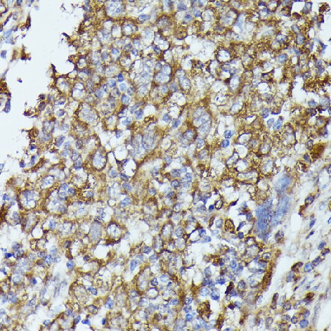 Immunohistochemistry of paraffin-embedded Human esophageal cancer using TBCB Polyclonal Antibody at dilution of  1:100 (40x lens).