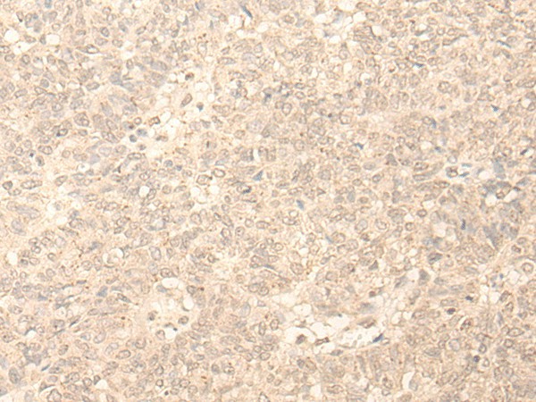 Immunohistochemistry of paraffin-embedded Human ovarian cancer tissue  using PLEKHA1 Polyclonal Antibody at dilution of 1:30(?200)