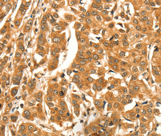 Immunohistochemistry of paraffin-embedded Human breast cancer tissue using DIRAS1 Polyclonal Antibody at dilution 1:52