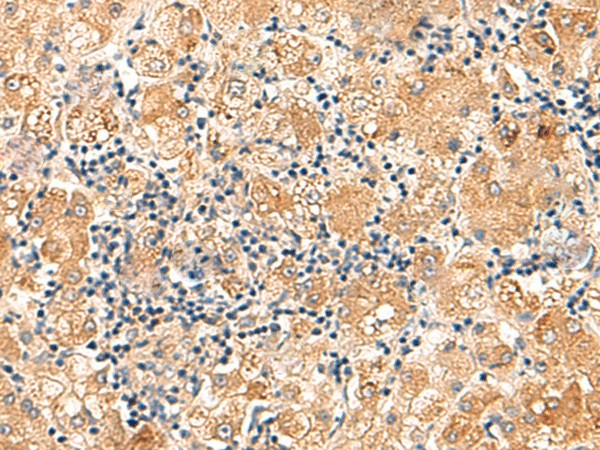 Immunohistochemistry of paraffin-embedded Human liver cancer tissue  using EIF3K Polyclonal Antibody at dilution of 1:75(?200)