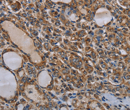 Immunohistochemistry of paraffin-embedded Human thyroid cancer tissue using MT-ND6 Polyclonal Antibody at dilution 1:40