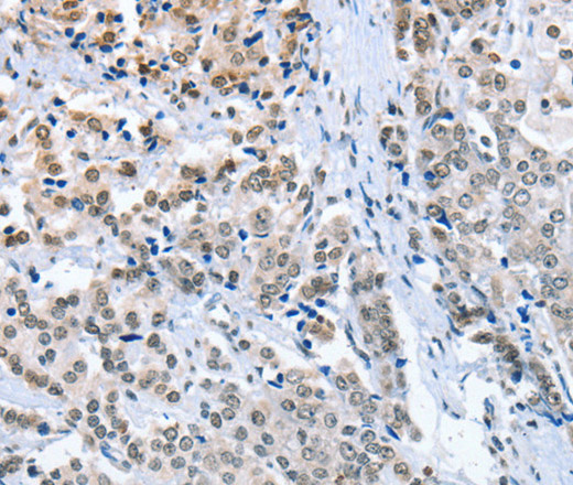 Immunohistochemistry of paraffin-embedded Human prostate cancer using ELAVL1 Polyclonal Antibody at dilution of 1:50