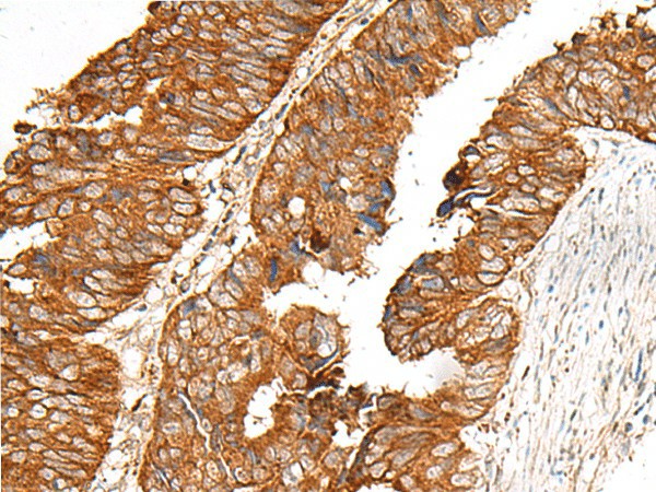 Immunohistochemistry of paraffin-embedded Human colorectal cancer tissue  using MBOAT4 Polyclonal Antibody at dilution of 1:30(?200)