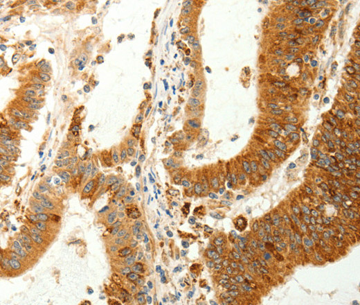 Immunohistochemistry of paraffin-embedded Human colon cancer using RARRES1 Polyclonal Antibody at dilution of 1:60