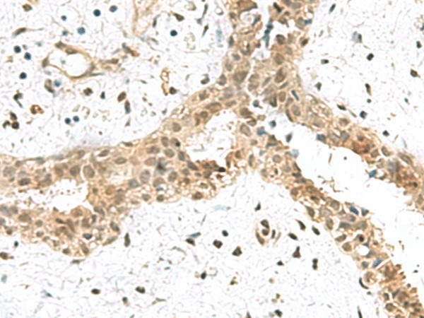 Immunohistochemistry of paraffin-embedded Human breast cancer tissue  using ELOC Polyclonal Antibody at dilution of 1:55(?200)