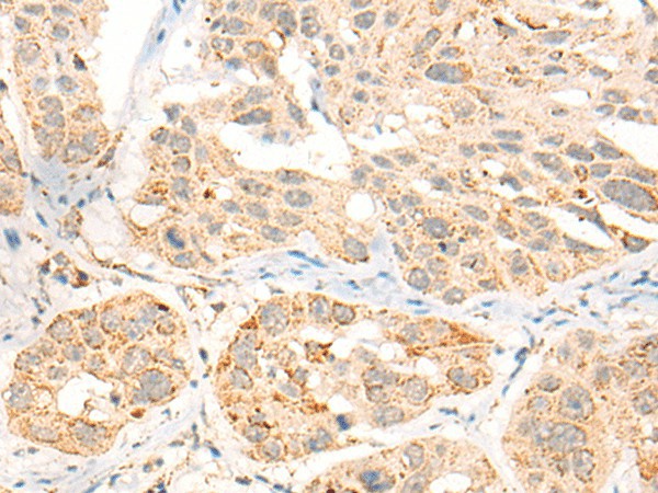 Immunohistochemistry of paraffin-embedded Human esophagus cancer tissue  using CCT8L2 Polyclonal Antibody at dilution of 1:45(?200)