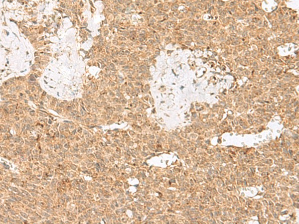 Immunohistochemistry of paraffin-embedded Human ovarian cancer tissue  using LGALSL Polyclonal Antibody at dilution of 1:25(?200)