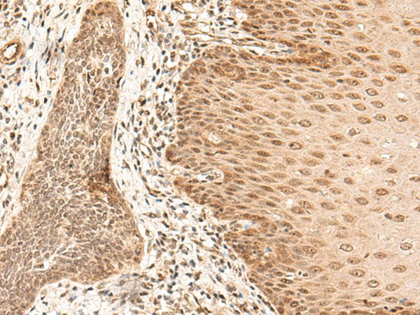 Immunohistochemistry of paraffin-embedded Human esophagus cancer tissue  using ARMC8 Polyclonal Antibody at dilution of 1:40(?200)