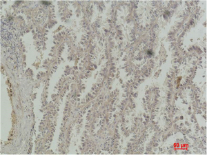 Immunohistochemistry of paraffin-embedded Human lung carcinoma tissue with CREB1 Monoclonal Antibody