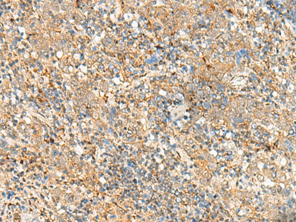 Immunohistochemistry of paraffin-embedded Human cervical cancer tissue  using FKBP1A Polyclonal Antibody at dilution of 1:55(?200)