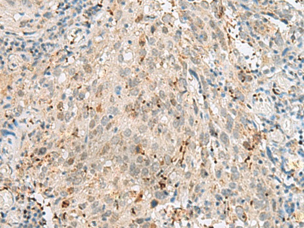 Immunohistochemistry of paraffin-embedded Human cervical cancer tissue  using GTF3C2 Polyclonal Antibody at dilution of 1:45(?200)