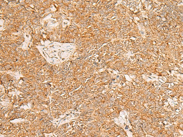 Immunohistochemistry of paraffin-embedded Human ovarian cancer tissue  using PDCD4 Polyclonal Antibody at dilution of 1:35(?200)