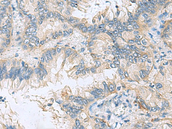 Immunohistochemistry of paraffin-embedded Human lung cancer tissue  using TAGLN3 Polyclonal Antibody at dilution of 1:70(?200)