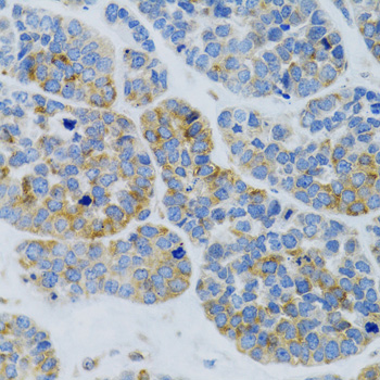 Immunohistochemistry of paraffin-embedded Human esophageal cancer using MBL2 Polyclonal antibody at dilution of 1:100 (40x lens).Perform microwave antigen retrieval with 10 mM PBS buffer pH 7.2 before commencing with IHC staining protocol