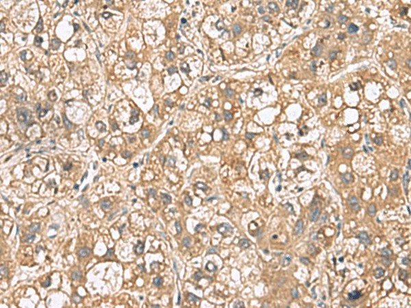 Immunohistochemistry of paraffin-embedded Human liver cancer tissue  using PTPRS Polyclonal Antibody at dilution of 1:110(?200)