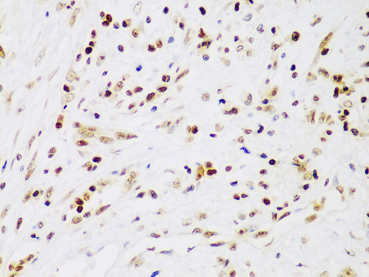 Immunohistochemistry of paraffin-embedded human liver cancer using IKKβ Polyclonal Antibody at dilution of 1:100 (40x lens).Perform microwave antigen retrieval with 10 mM PBS buffer pH 7.2 before commencing with IHC staining protocol.