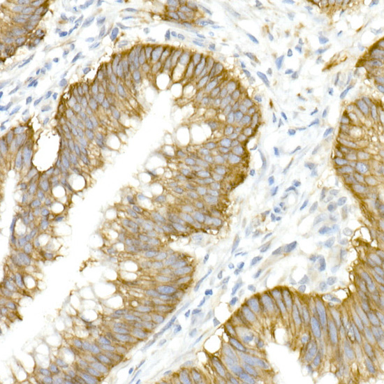 Immunohistochemistry of paraffin-embedded human colon carcinoma using SLC12A2 Polyclonal Antibody at dilution of 1:50 (40x lens).Perform high pressure antigen retrieval with 10 mM citrate buffer pH 6.0 before commencing with IHC staining protocol.