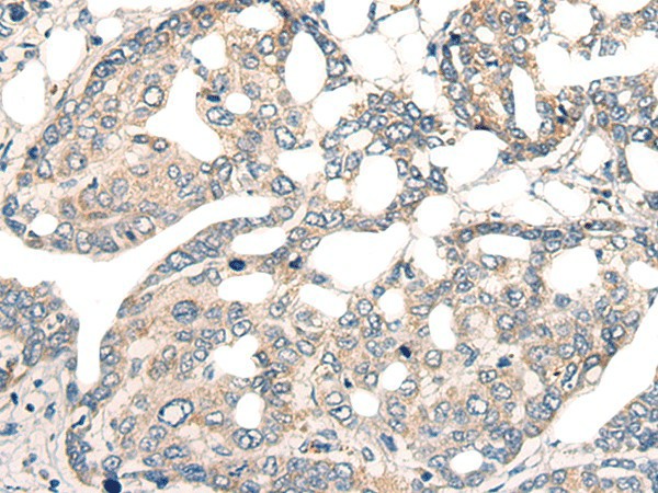 Immunohistochemistry of paraffin-embedded Human liver cancer tissue  using CORO2A Polyclonal Antibody at dilution of 1:45(?200)