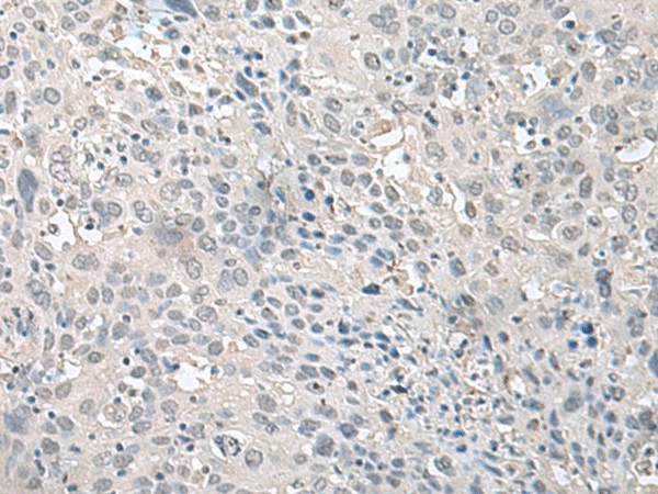 Immunohistochemistry of paraffin-embedded Human cervical cancer tissue  using EPM2A Polyclonal Antibody at dilution of 1:75(?200)