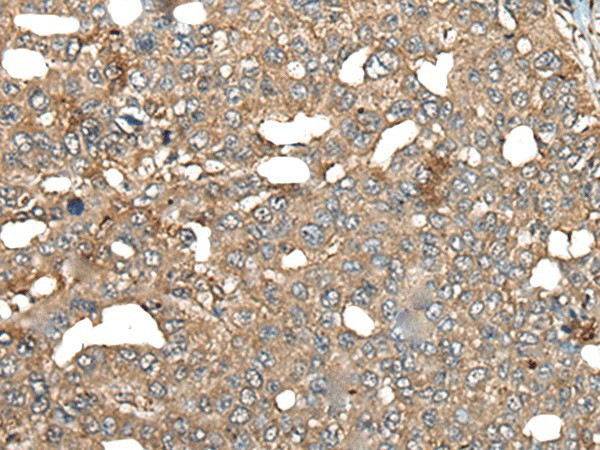 Immunohistochemistry of paraffin-embedded Human liver cancer tissue  using BRD9 Polyclonal Antibody at dilution of 1:80(?200)