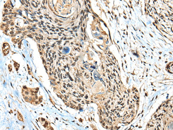 Immunohistochemistry of paraffin-embedded Human esophagus cancer tissue  using CBFB Polyclonal Antibody at dilution of 1:40(?200)