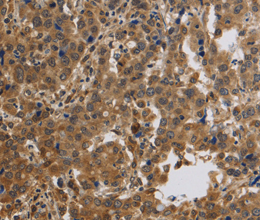 Immunohistochemistry of paraffin-embedded Human liver cancer using KCNMB4 Polyclonal Antibody at dilution of 1:40