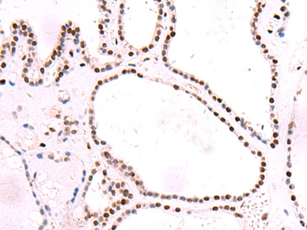 Immunohistochemistry of paraffin-embedded Human thyroid cancer tissue  using NASP Polyclonal Antibody at dilution of 1:55(?200)