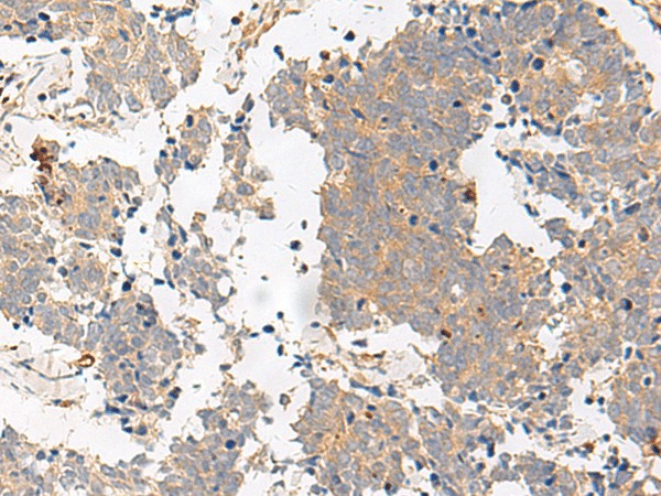 Immunohistochemistry of paraffin-embedded Human lung cancer tissue  using GPR153 Polyclonal Antibody at dilution of 1:40(?200)