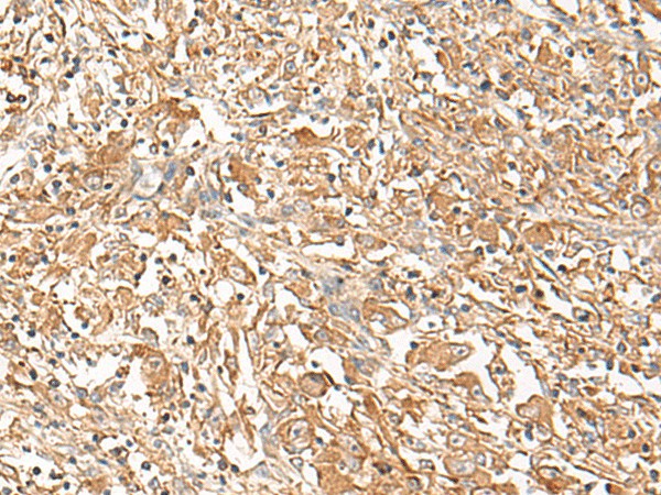 Immunohistochemistry of paraffin-embedded Human liver cancer tissue  using CORO2A Polyclonal Antibody at dilution of 1:50(?200)