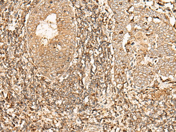 Immunohistochemistry of paraffin-embedded Human esophagus cancer tissue  using GALR2 Polyclonal Antibody at dilution of 1:40(?200)