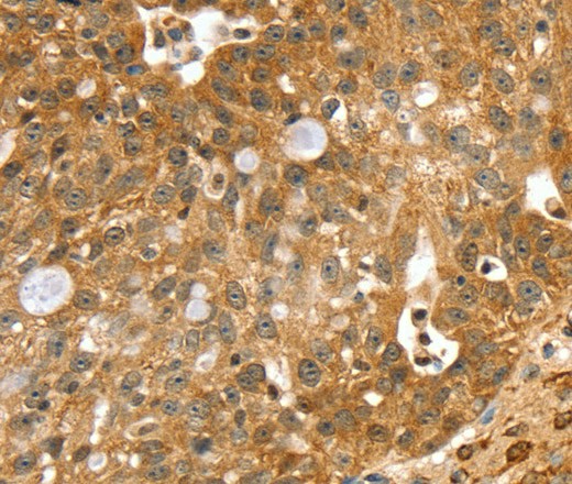 Immunohistochemistry of paraffin-embedded Human breast cancer tissue using SORT1 Polyclonal Antibody at dilution 1:40